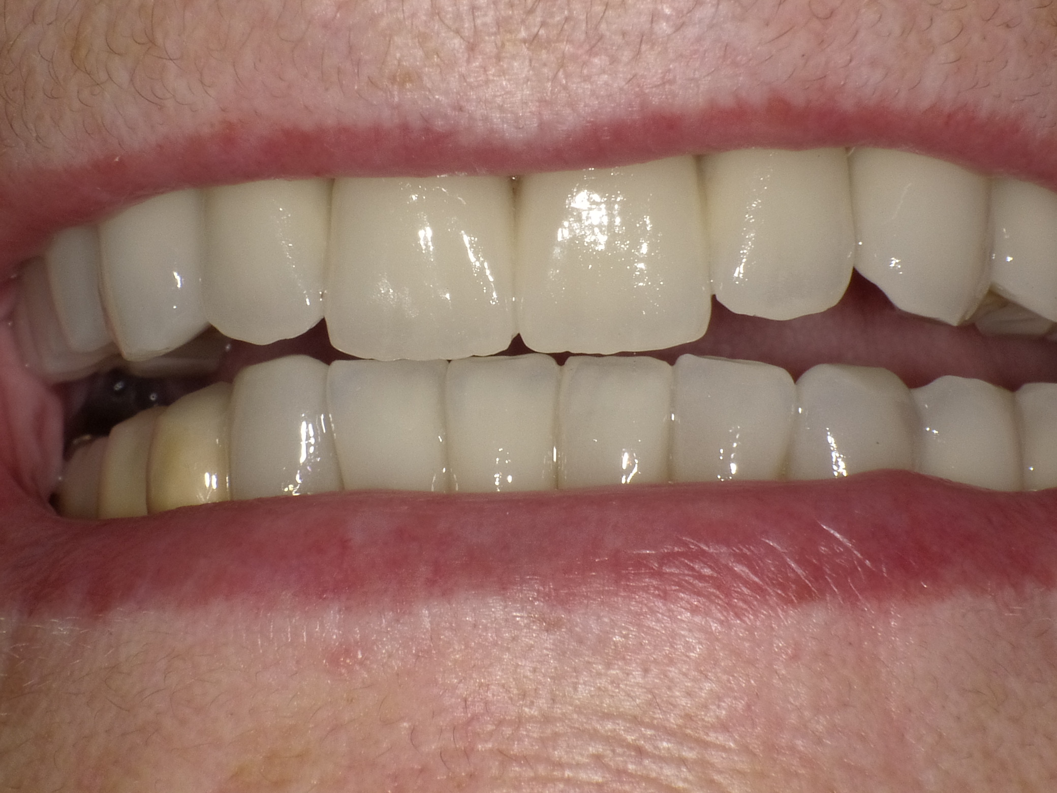 Korrektur in 2 Langzeitterminen mit Vollkeramik